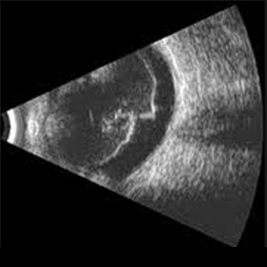 Bright (B Scan) Ultrasound